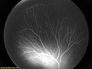 Figure 1: Fluorescein angiography (FA) of the right eye. There is an area of peripheral avascular retina with neovascular tufts along the border.