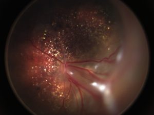 Figure 4: Fundus photography of the left eye. Intra-retinal cholesterol crystals remain after some resolution of exudates. A sub-retinal band with persistent exudates is observed extending anteriorly.