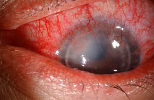 Figure 3 (right): Slit lamp photo of aggressive allograft rejection with active stromal vascularization and haze indicative of active graft rejection.