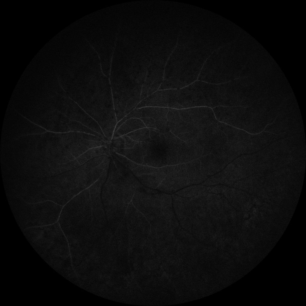 Susac's Syndrome image 21