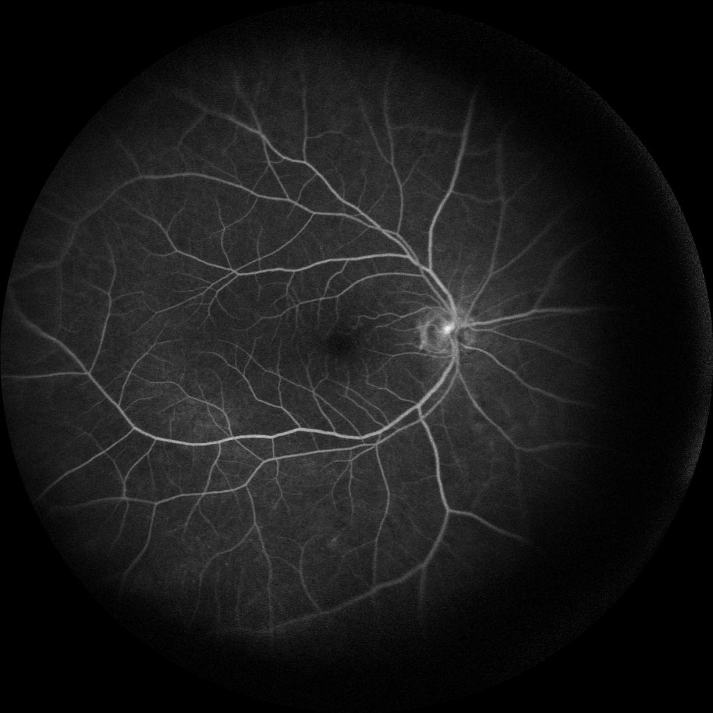 Susac's Syndrome image 57