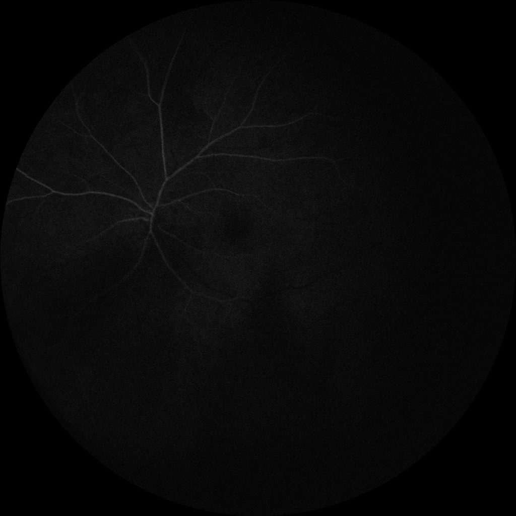 Susac's Syndrome image 14