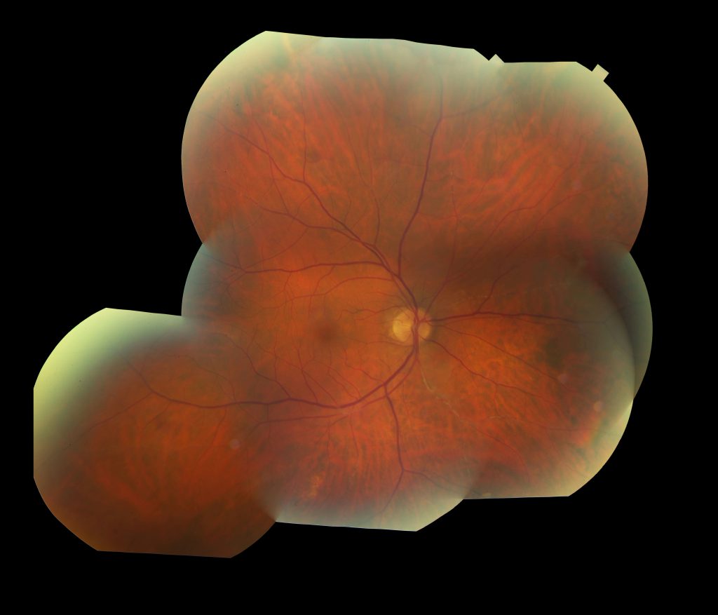 Susac's Syndrome image OD(b)