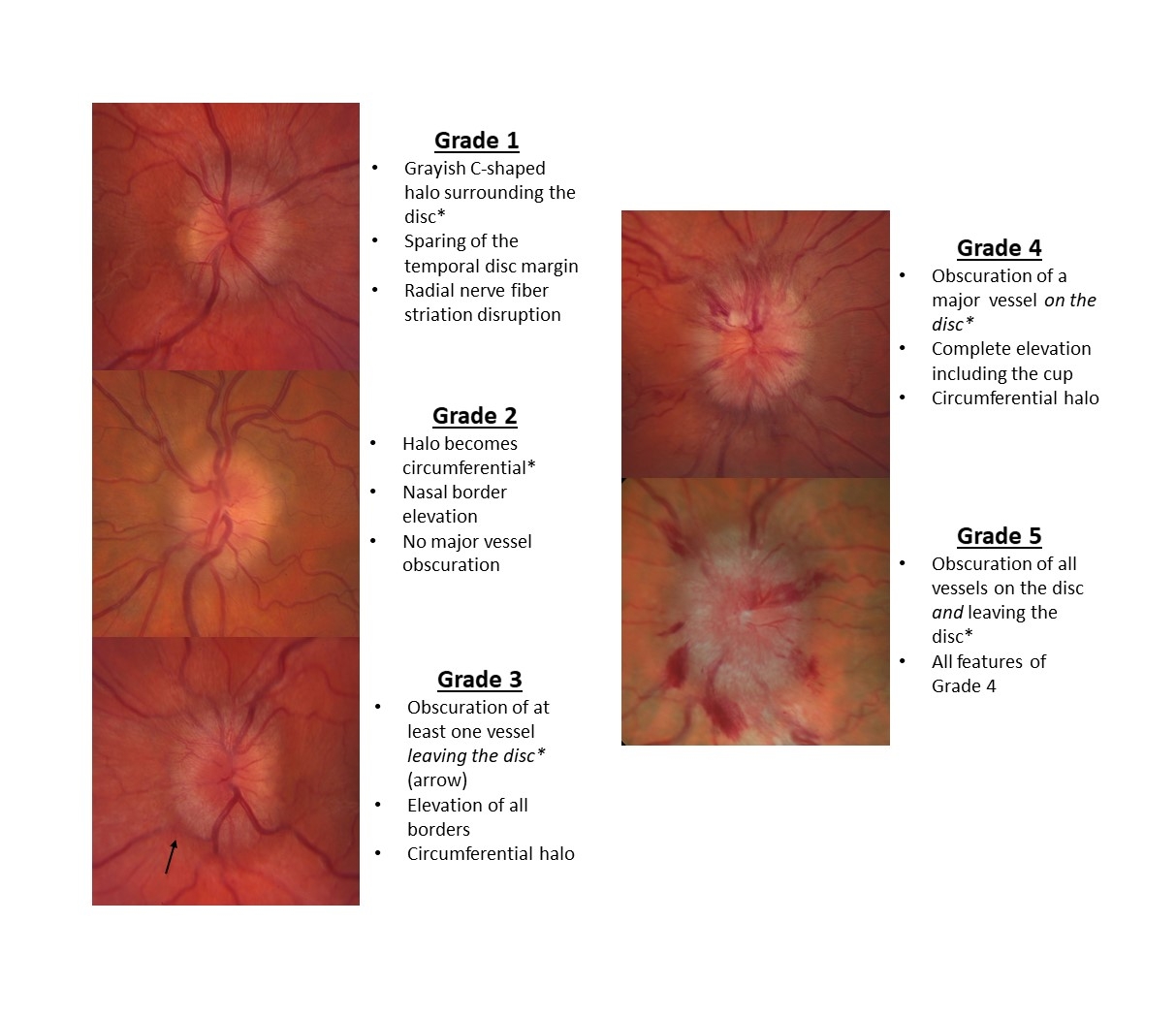 Moran CORE Disc Edema