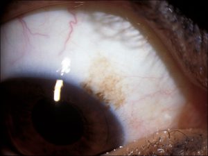 Mamalis_Conjunctiva_51_unlabeled