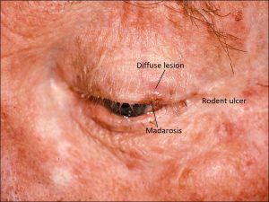 Mamalis Eyelid 55 labeled