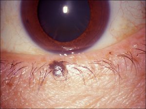 Mamalis Eyelid 65 unlabeled