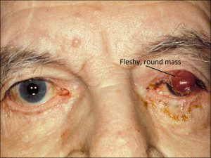 Mamalis Eyelid 73 labeled