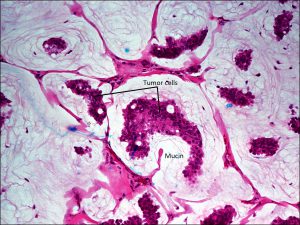 Mamalis Eyelid 75 labeled