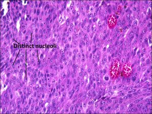 Mamalis Tumor 06 labeled