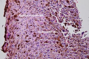 Mamalis Tumor 08 labeled