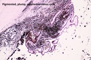 Mamalis Tumor 11 labeled