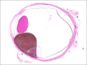 Mamalis Tumor 15 unlabeled