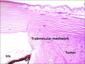 Mamalis Tumor 16 labeled