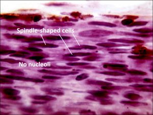 Mamalis Tumor 18 labeled