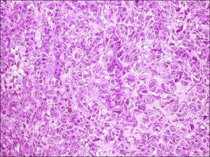 Mamalis Tumor 21 unlabeled