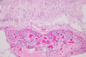 Mamalis Tumor 23 unlabeled