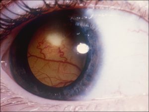 Mamalis Tumor 25 unlabeled