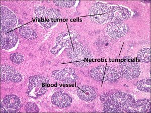 Mamalis Tumor 29 labeled