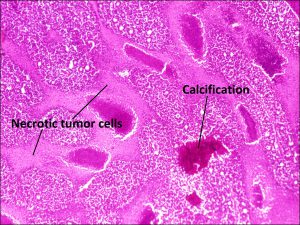 Mamalis Tumor 30 labeled