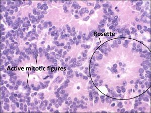 Mamalis Tumor 31 labeled