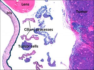 Mamalis Tumor 34 labeled