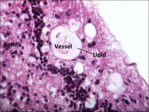 Mamalis Tumor 38 labeled