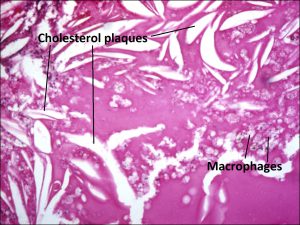 Mamalis Tumor 39 labeled