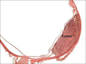 Mamalis Tumor 49 labeled