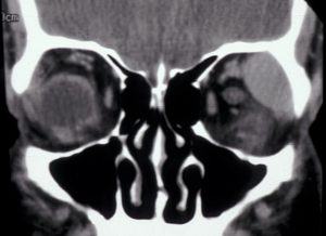 Mamalis Orbit 36 Unlabeled