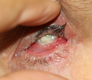 Figure 2b: Follow-up photographs of the patient with an acute exacerbation of OCP.