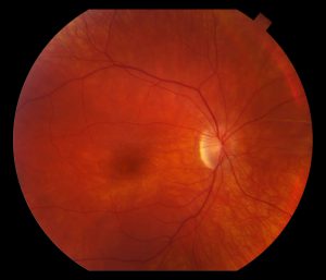 Fundus exam revealed a “beaten metal” macula and lightly pigmented peripheral retina (Figure 1-1)