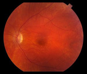 Fundus exam revealed a “beaten metal” macula and lightly pigmented peripheral retina (Figure 1-2)