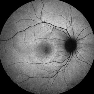 Optic nerves were normal. Fundus autoflurorescence demonstrated parafoveal hyperautoflurescence (Figure 2-1)