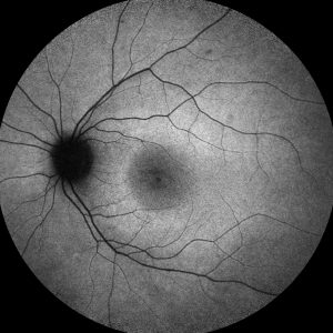 Optic nerves were normal. Fundus autoflurorescence demonstrated parafoveal hyperautoflurescence (Figure 2-2)