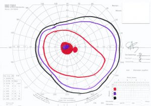 On Goldmann perimetry, the patient had superior and nasal constriction of his visual fields and diminished central vision OU with a paracentral scotoma in his left eye (Figure 3-1).
