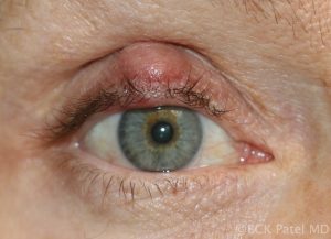 Patel_119308_Fig_11_Chronic_chalazion