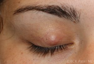 Fig_5_Chalazion