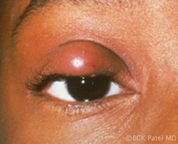 Fig_6_Chalazion_inflamed