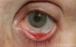 Fig_8_Internal_hordeolum_with_granuloma