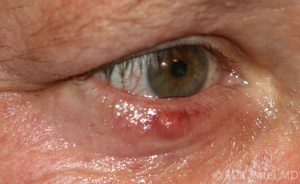 Patel_119308_Fig_9_Chalazion_with_outward_point