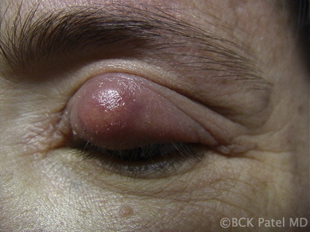 Fig 12. “Giant chalzion”: When a giant chalazion is seen, beware of other surrounding Meibomian glands being involved. These need incision and curettage