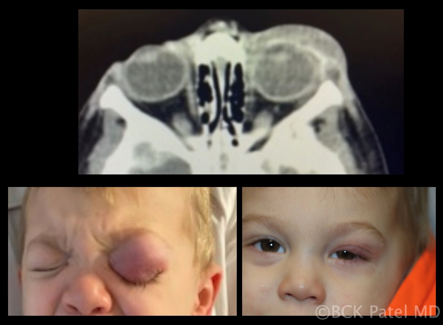 Fig 15. Underlying chalazia should be suspected with children present with preseptal cellulitis. In this child, there are several chalazia which are seen on the CT scan performed to ensure there were no postseptal changes. Treatment of the chalazia resolves the problem