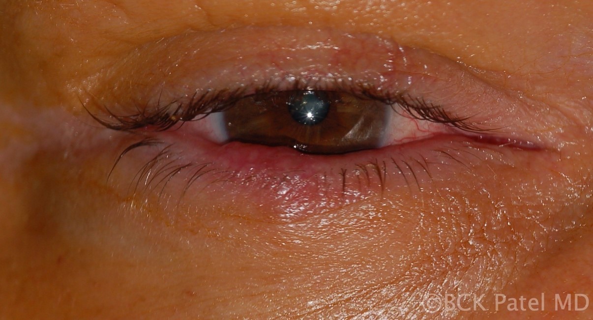 Fig 23. Chronic meibomianitis in a patient with chronic Meibomian gland disease with recurrent chalazia. These patients will need oral tetracycline together with management of any associated acne rosacea in addition to lid margin management. There can be reduction in eyelashes even in the absence of malignancy in these patients but if in doubt, a biopsy should be performed