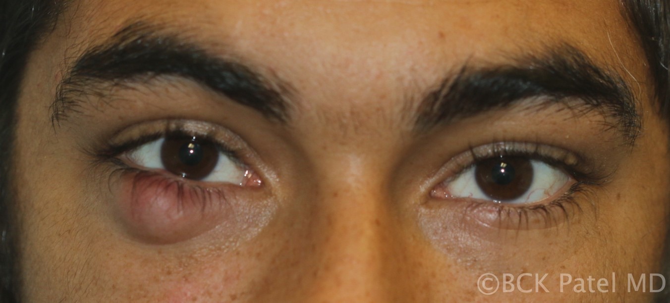 Fig 38. Example of multiple chronic chalazia affecting all four eyelids. Contrary to popular belief, there is no evidence that diet has any effect on chalazia. Many such patients will also have no evidence of acne rosacea or blepharitis or meibomianitis
