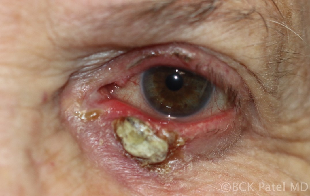 Fig 46. Chronic chalazion with anterior ulceration and calcification. In such lesions, it is important to send samples for histopathology to exclude underlying malignancy