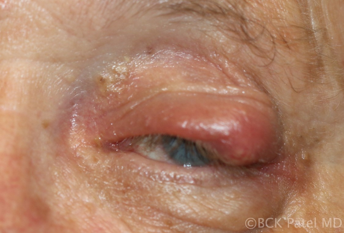 Fig 47. Acute chalazion with spread of infection into the subcutaneous tissue leading to early preseptal cellulitis.