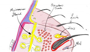 Fig 1. Cross-section depiction of the eyelid margin showing the relationship of the Meibomian gland, the eyelashes and the glands of Zeis and Moll