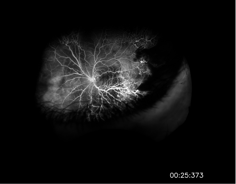 Image 2: Widefield fluorescein angiography taken after initial vitrectomy demonstrating telangiectatic vessels with terminal light bulb aneurysms, capillary nonperfusion, and perivascular leakage.
