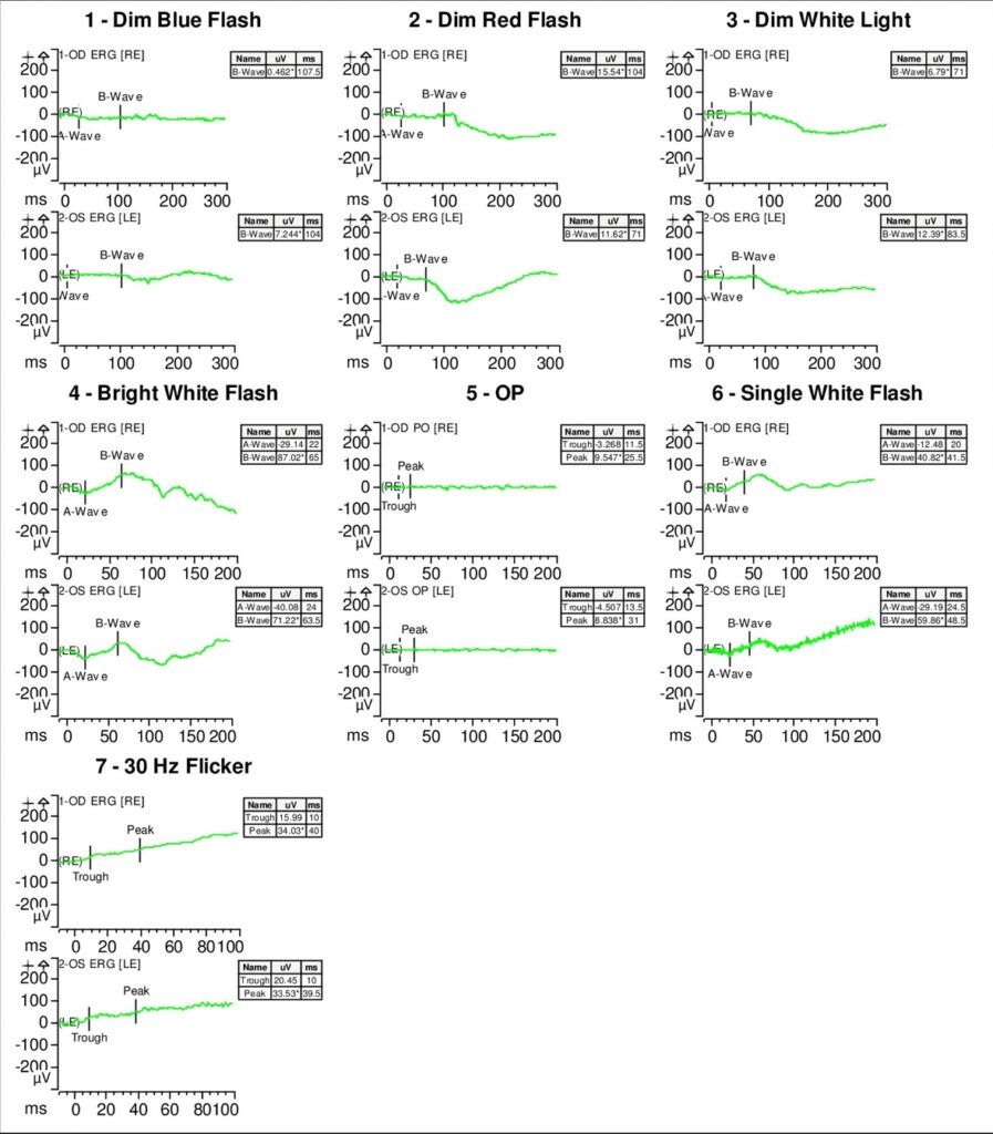 Figure 5. Full-field electroretinogram (ERG) showed diminished scotopic and photopic bright white flashes OU and 30 Hz flicker response that was delayed and diminished in amplitude OU.